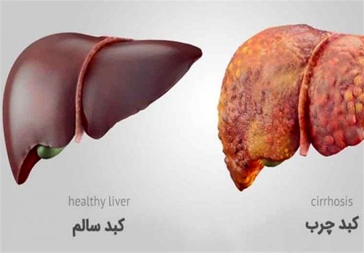 انواع کبد چرب/ دستورالعمل ساده برای درمان این بیماری