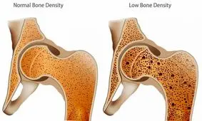 دلایل پوکی استخوان
