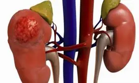 10 نشانه نارسایی کلیه