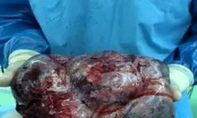 خارج کردن توده ۱۵ کیلوگرمی از شکم یک زن
