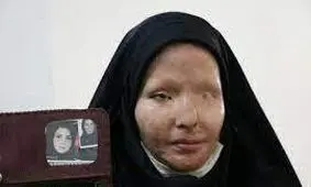 «سیما افشاری» قربانی اسیدپاشی ضارب خود را پس از ۱۱ سال بخشید