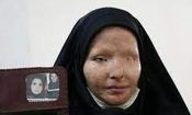«سیما افشاری» قربانی اسیدپاشی ضارب خود را پس از ۱۱ سال بخشید
