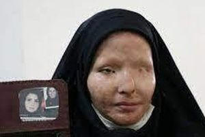 «سیما افشاری» قربانی اسیدپاشی ضارب خود را پس از ۱۱ سال بخشید