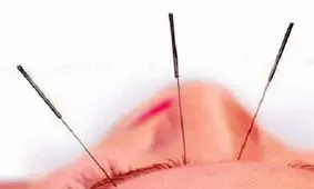 طب سوزنی در کاهش وزن موثر است​