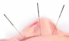 طب سوزنی در کاهش وزن موثر است​