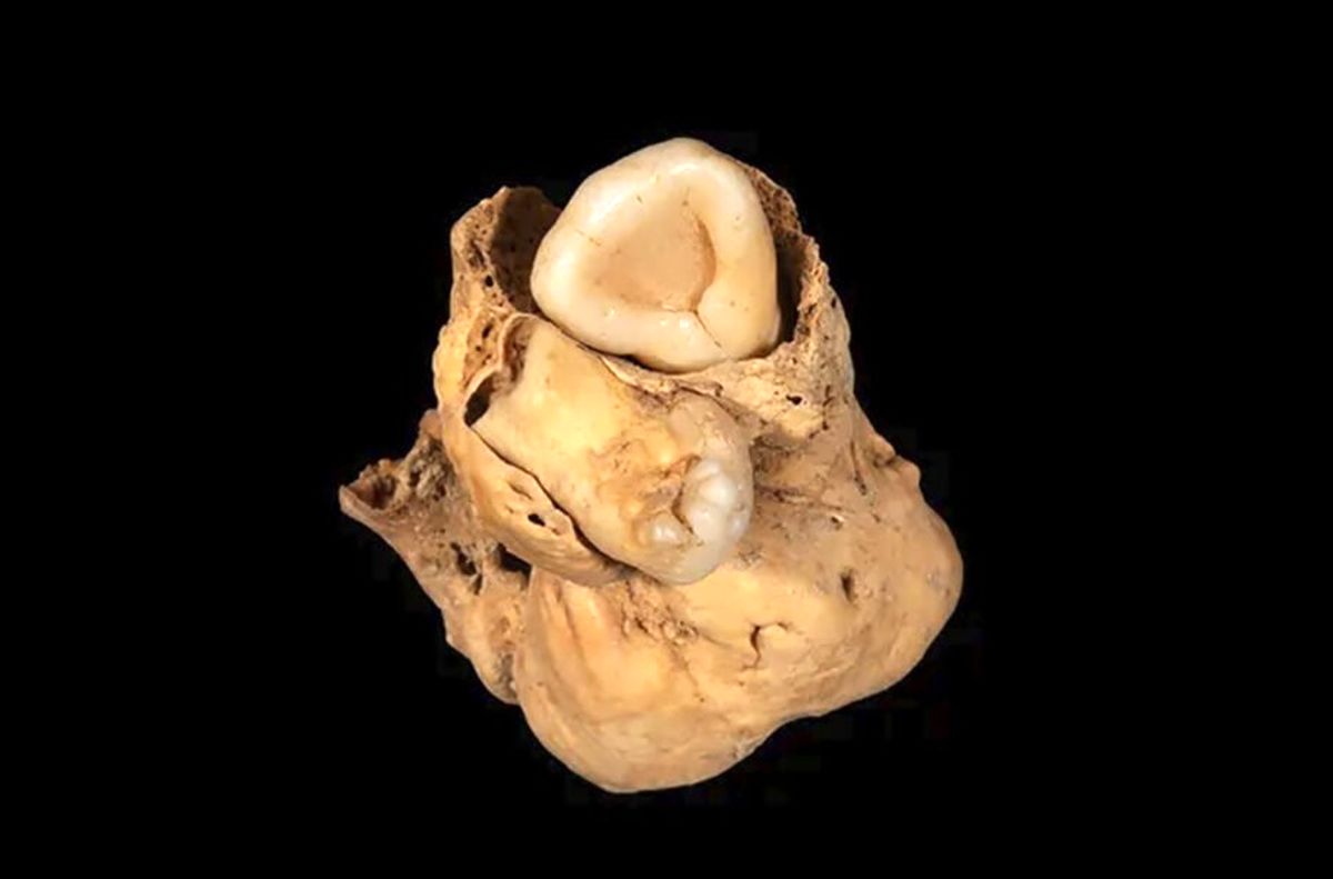  کشف توموری با 2 دندان در لگن فسیل 3000 ساله یک زن مصری