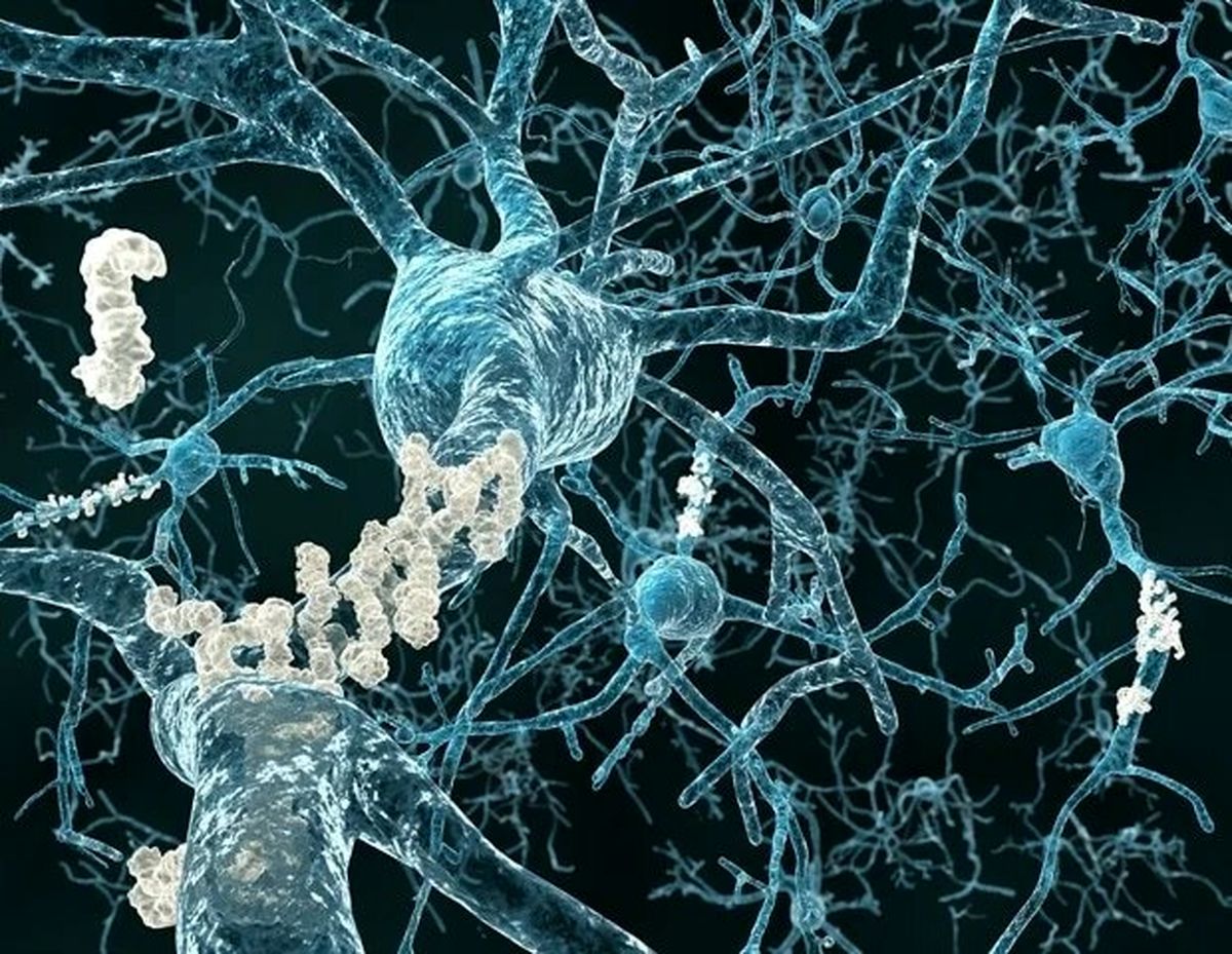 نقش حسگر متابولیک در بیماری آلزایمر