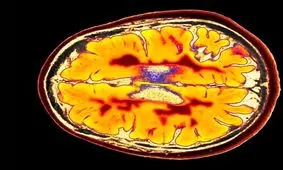 یک کشف مهم درباره MS ، نقش مهم باکتری هایی که میزبان حیوانی دارند در بروز بیماری