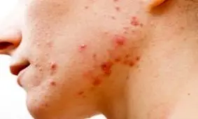 مواد غذایی که باعث جوش می شوند