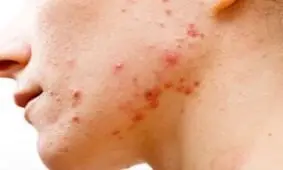 مواد غذایی که باعث جوش می شوند