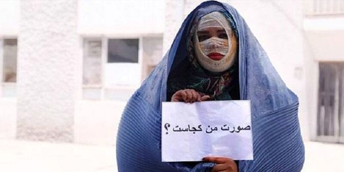 معروفترین قربانی اسیدپاشی: هنوز دیهام را نگرفتهام