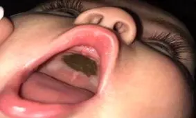 لکه سیاه و عجیب سقف دهان نوزاد! + عکس