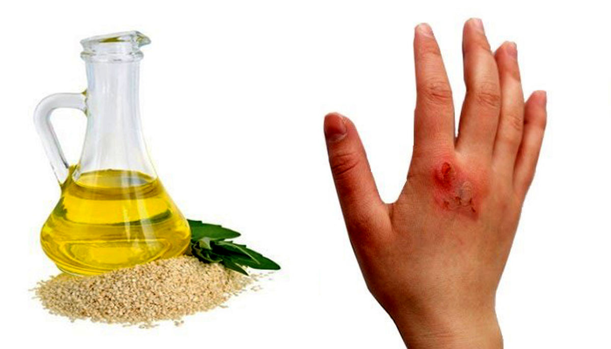 خواص روغن کنجد برای سوختگی و سایر بیماریها