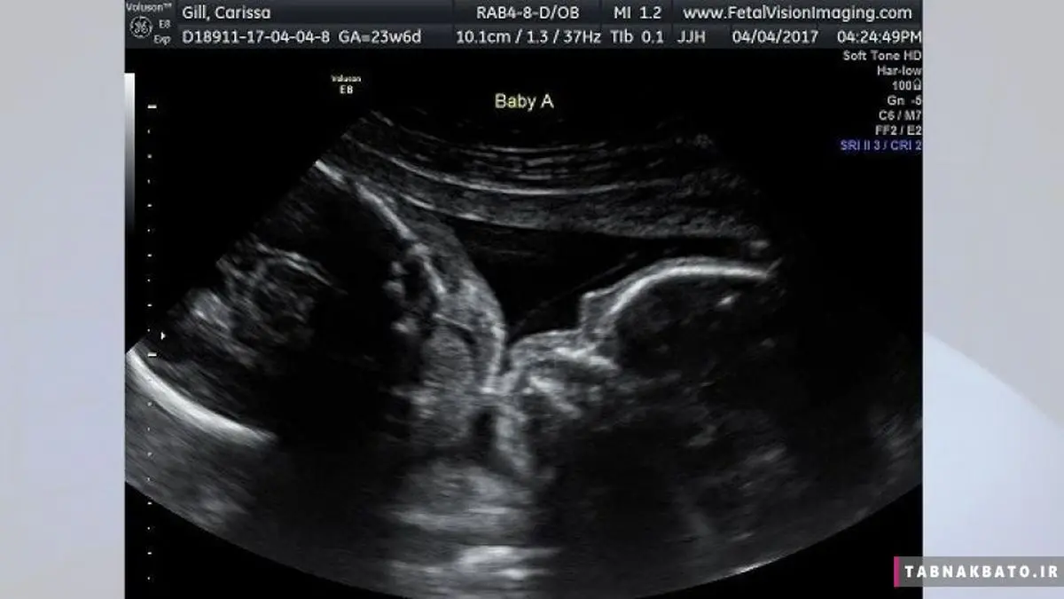 سونوگرافی و دوقلوهایی در حال بوسیدن یکدیگر در رحم مادر