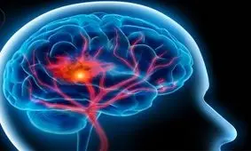 شناخت علائم خطر سکته مغزی