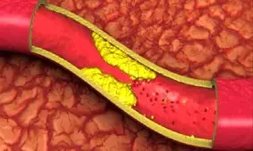 اولین علائم افزایش چربی خون