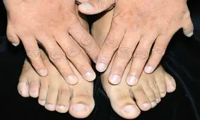 اختلالی کمیاب اما شگفت انگیز در تعداد انگشتان دست