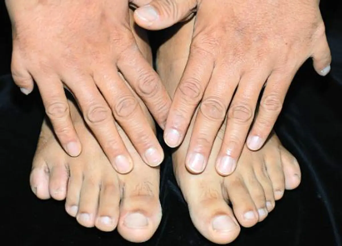 اختلالی کمیاب اما شگفت انگیز در تعداد انگشتان دست