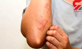 سارکوئیدوز را بیشتر بشناسید