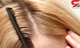 درمان خارش سر با ترفندهای ساده