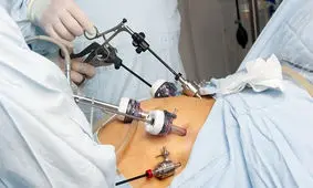 عمل بای پس معده؛ ویژگی‌ها، عوارض و مراقبت‌ها