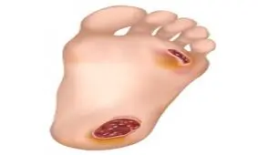 زخم پا در دیابتی ها جدی است/ نقش طب فیزیکی و توانبخشی