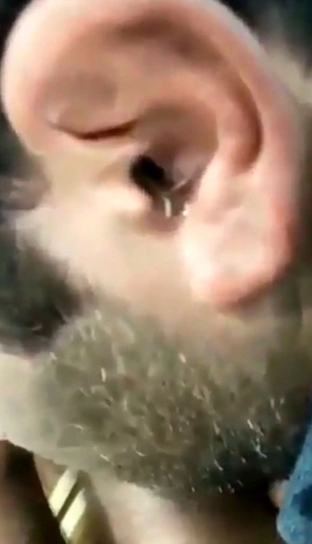 خارج کردن هزار پا از گوش