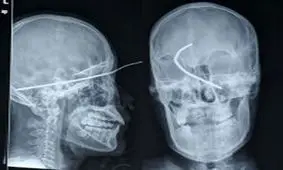 ابتلا به سرطان با پرتوهای رادیولوژی و سی تی اسکن