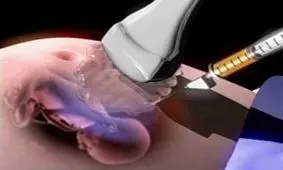 آمنیوسنتز در بارداری، چرا انجام می شه؟