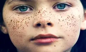 هرآنچه از روش‌های خانگی مقابله با لکه‌های پوست باید بدانید