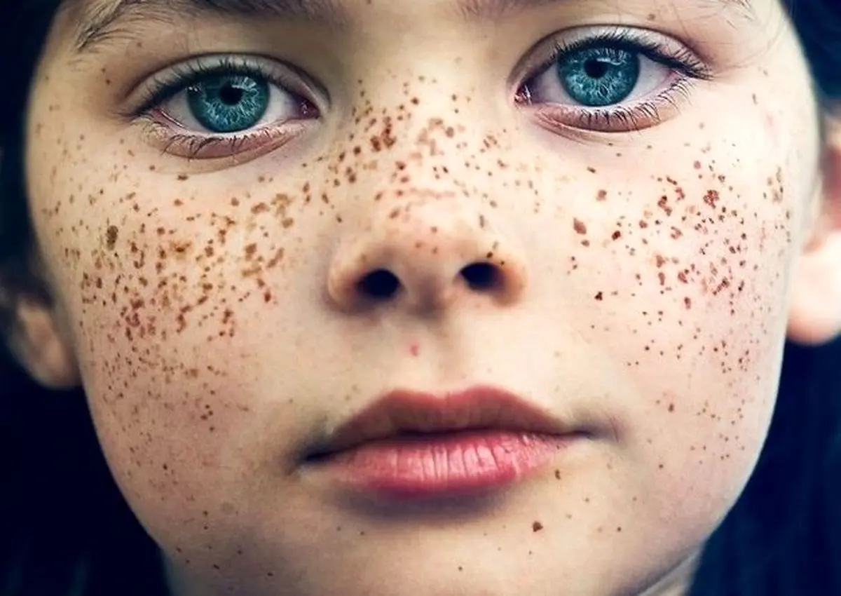 هرآنچه از روش‌های خانگی مقابله با لکه‌های پوست باید بدانید