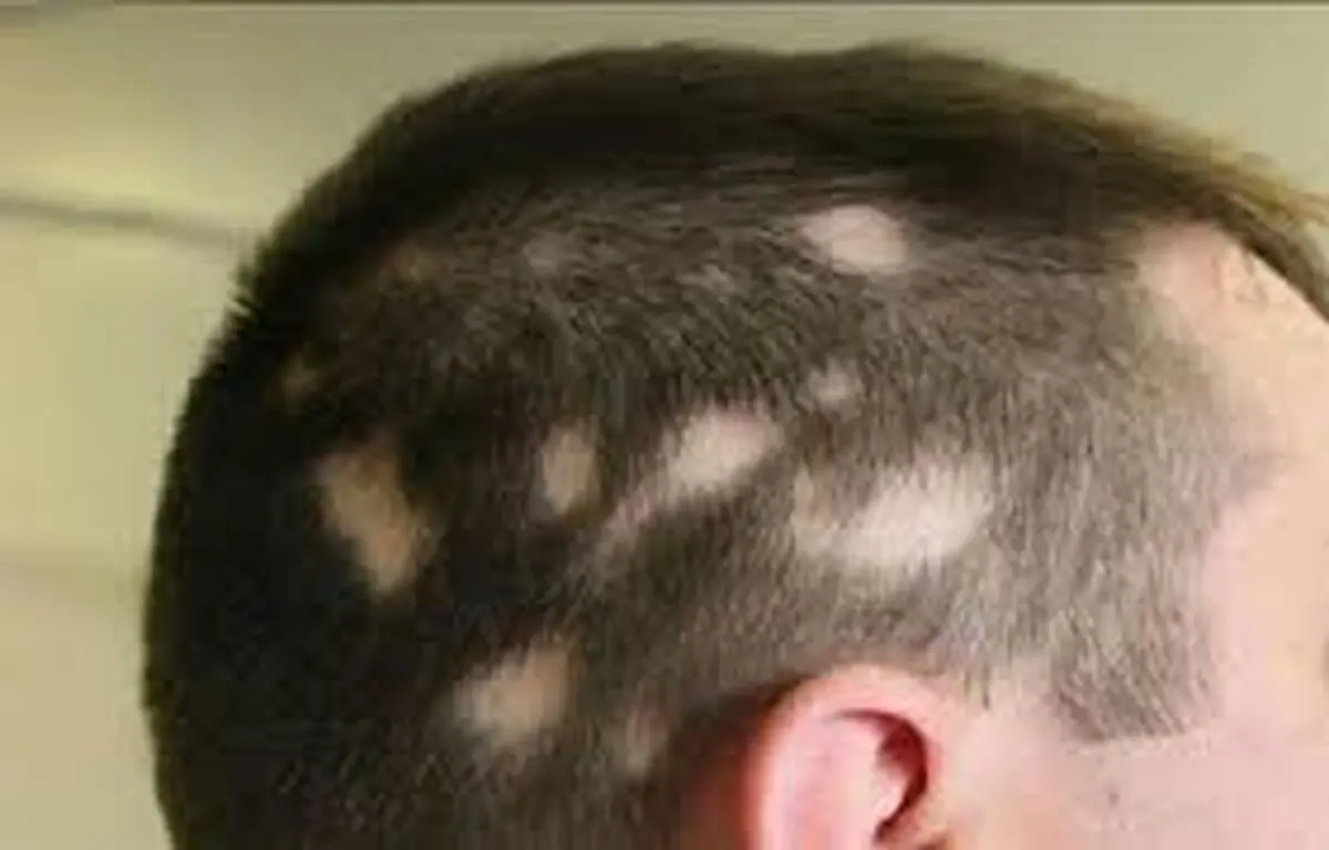 راهکار طب‌سنتی برای ریزش موی سکه‌ای +علل ابتلا به آلوپسی آره آتا