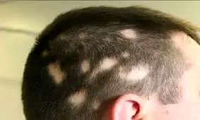 راهکار طب‌سنتی برای ریزش موی سکه‌ای +علل ابتلا به آلوپسی آره آتا