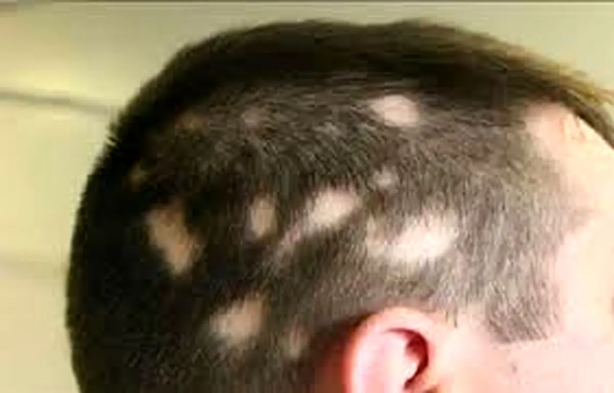 راهکار طب‌سنتی برای ریزش موی سکه‌ای +علل ابتلا به آلوپسی آره آتا