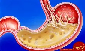 قدرت باور نکردنی اسید معده انسان!