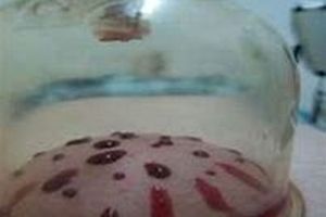 انواع حجامت و فواید آن / حجامت گوش، زیرشکم، ران پاها، کمر، نقره و …