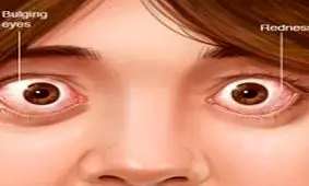 چرا چشم‌ها از حدقه بیرون می‌زند؟