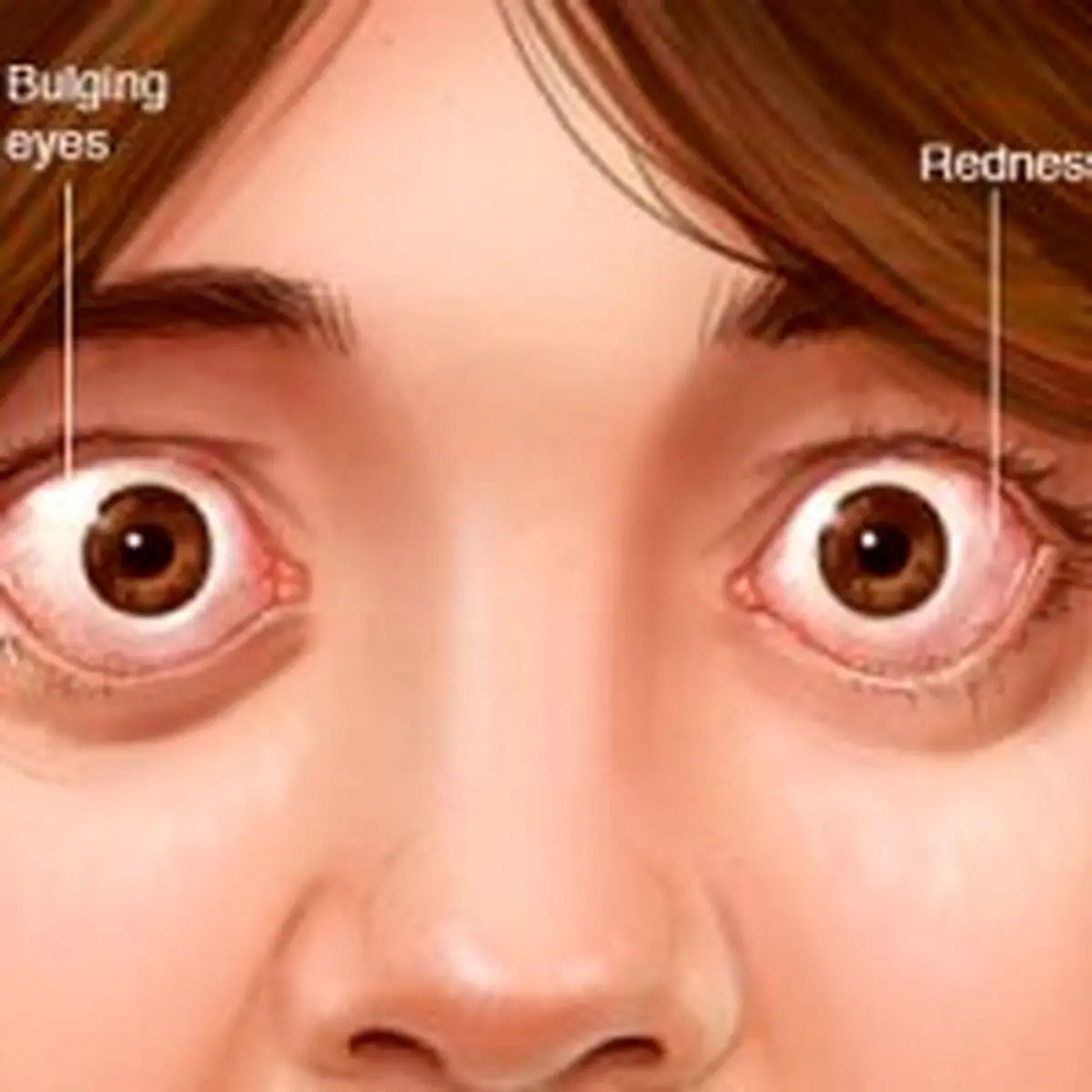 چرا چشم‌ها از حدقه بیرون می‌زند؟