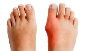 دلایل انحراف انگشت شست پا/ جراحی در چه مواردی ضروری است؟