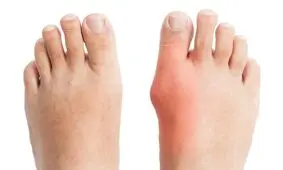 دلایل انحراف انگشت شست پا/ جراحی در چه مواردی ضروری است؟