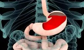 درمانی عجیب برای شایع‌ترین بیماری گوارشی جهان که به گوشتان نخورده است