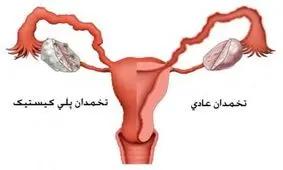 بارداری با وجود تخمدان پلی کیستیک، امکان داره؟