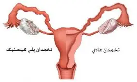 بارداری با وجود تخمدان پلی کیستیک، امکان داره؟