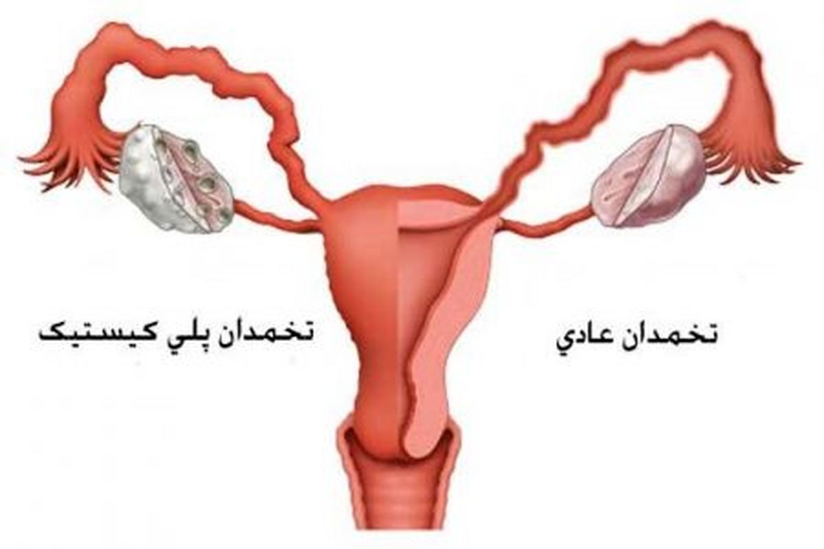 بارداری با وجود تخمدان پلی کیستیک، امکان داره؟