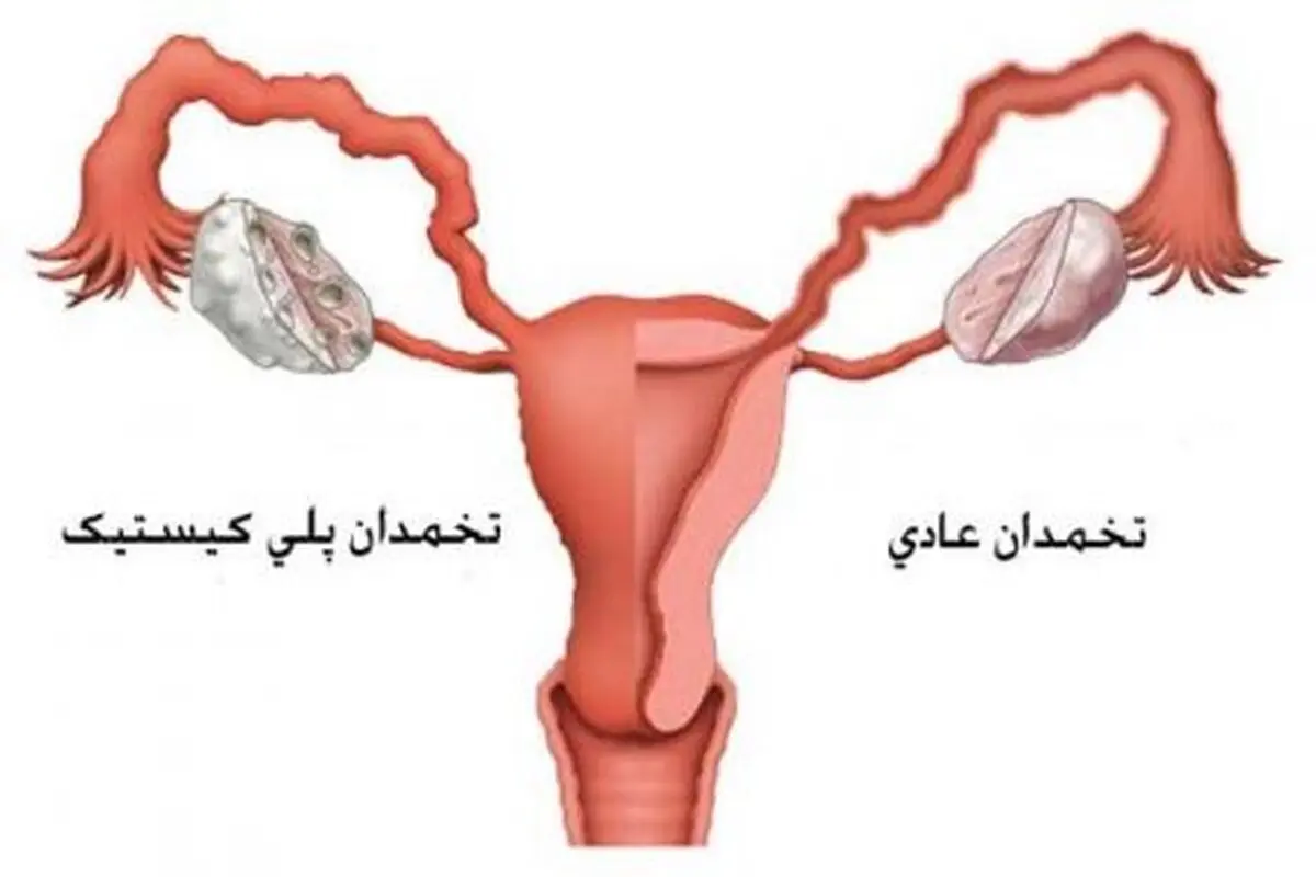 بارداری با وجود تخمدان پلی کیستیک، امکان داره؟