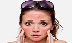 اگر دچار آفتاب سوختگی شدین این کلیپ بهتون کمک میکنه!