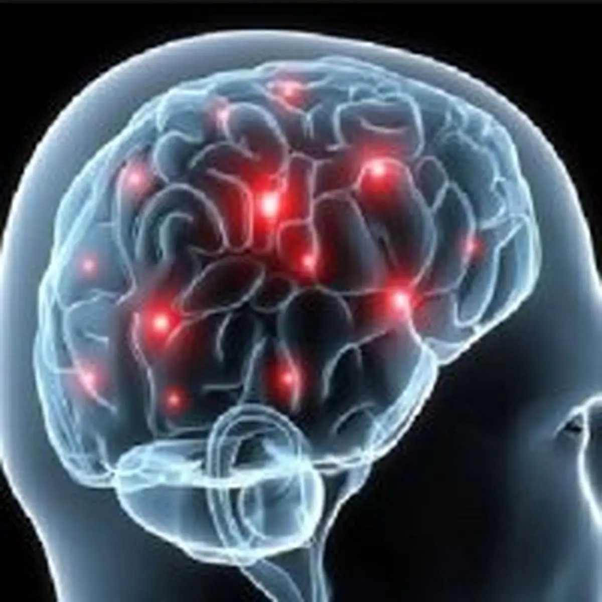 درمان افسردگی با تحریک فراجمجمه‌ای مغز