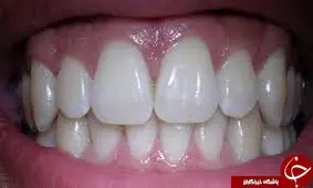 چطور لثه‌هایی سالم داشته باشیم+ ترفند‌هایی برای درمان لثه‌های تحلیل رفته