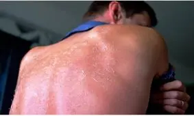 ۴ نشانه مسمومیت خورشیدی را بشناسید