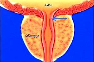 رابطه عجیب اندازه دور شکم آقایان و سرطان پروستات/ شکم گنده ها در خطر هستند!